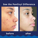 PanOxyl Acne Foaming Wash 28g 6